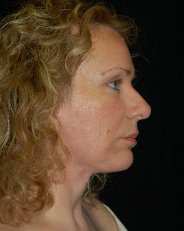 After thumbnail for Case 2 Facelift Before and After Photos