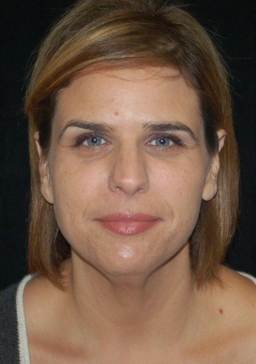 Before thumbnail for Case 7 Facelift Before and After Photos