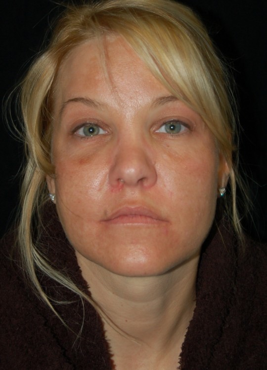 Before thumbnail for Case 13 Facial Fat Grafting Before and After Photos