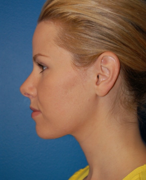 After thumbnail for Case 1 Neck Liposuction Before and After Photos