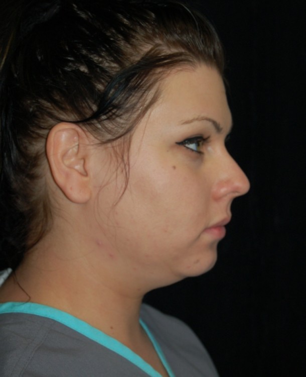 Before thumbnail for Case 2 Neck Liposuction Before and After Photos