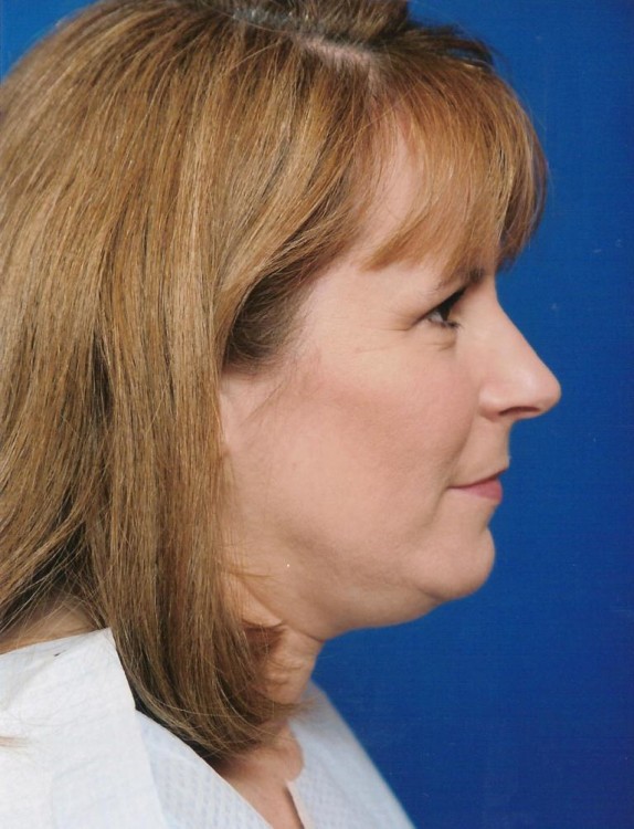 Before thumbnail for Case 7 Neck Liposuction Before and After Photos
