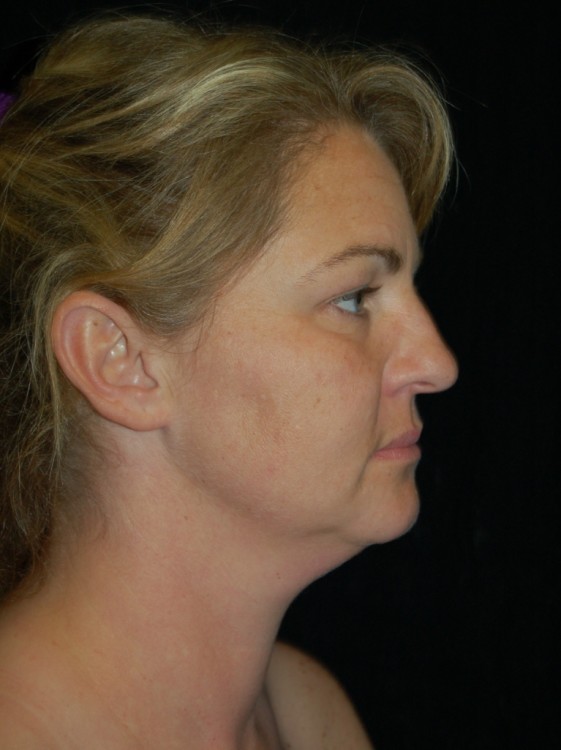 Before thumbnail for Case 8 Neck Liposuction Before and After Photos