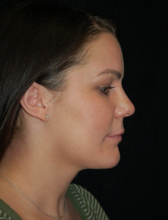 After thumbnail for Case 11 Neck Liposuction Before and After Photos