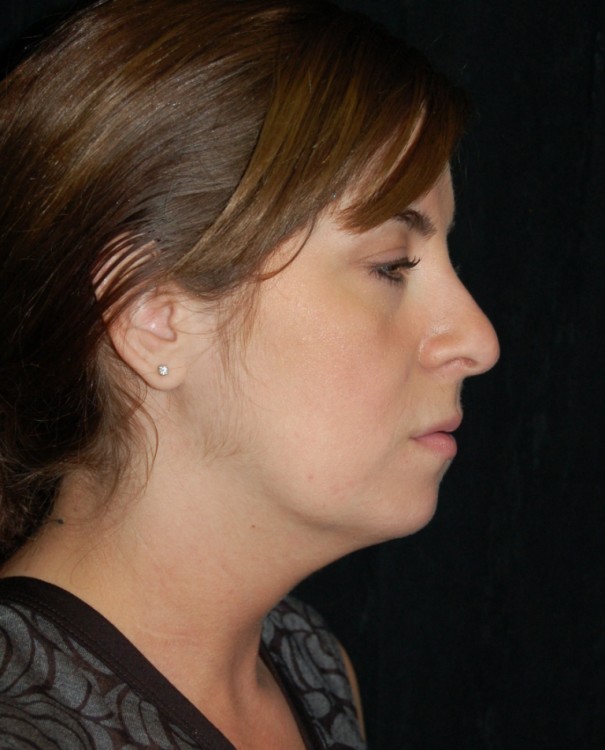 Before thumbnail for Case 14 Neck Liposuction Before and After Photos