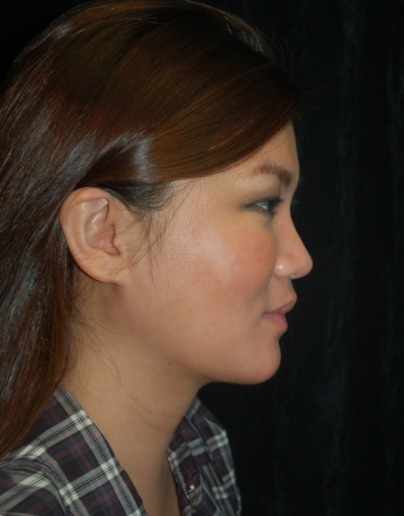 After thumbnail for Case 15 Neck Liposuction Before and After Photos