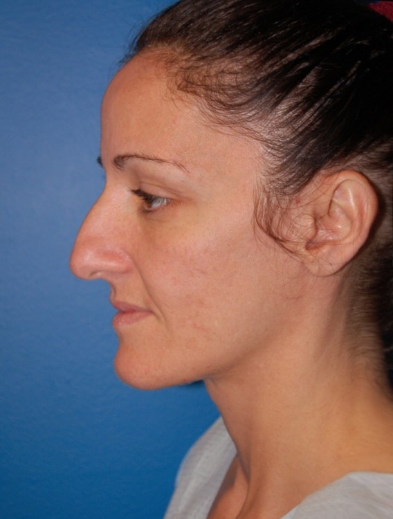 Before thumbnail for Case 1 Rhinoplasty Before and After Photos