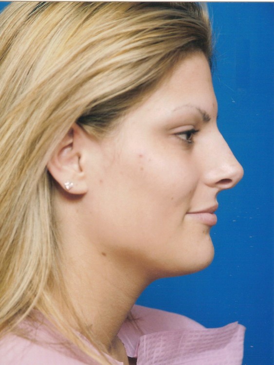 Before thumbnail for Case 12 Rhinoplasty Before and After Photos