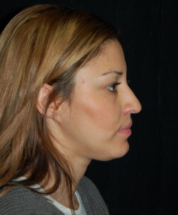 Before thumbnail for Case 13 Rhinoplasty Before and After Photos