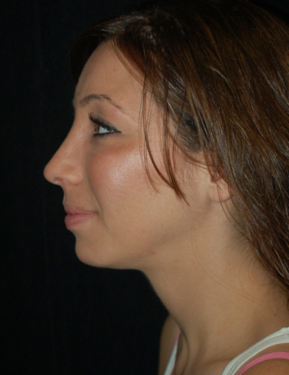 After thumbnail for Case 14 Rhinoplasty Before and After Photos