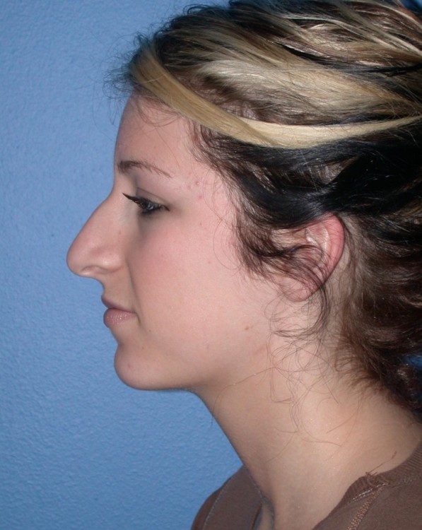 Before thumbnail for Case 15 Rhinoplasty Before and After Photos