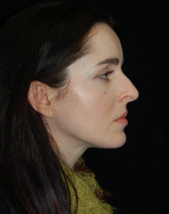 Before thumbnail for Case 50 Rhinoplasty Before and After Photos