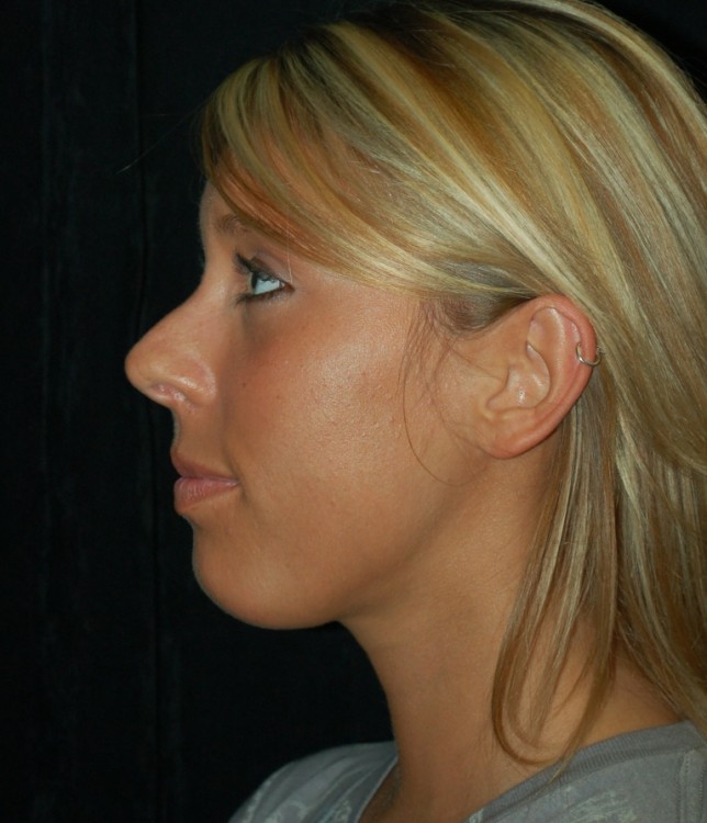 Before thumbnail for Case 53 Rhinoplasty Before and After Photos