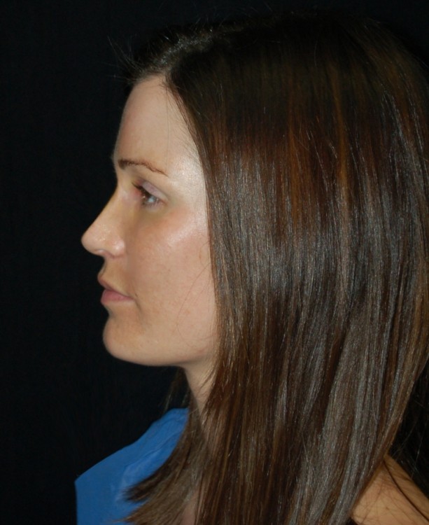 After thumbnail for Case 60 Rhinoplasty Before and After Photos