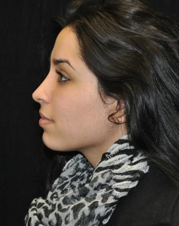 After thumbnail for Case 99 Rhinoplasty Before and After Photos