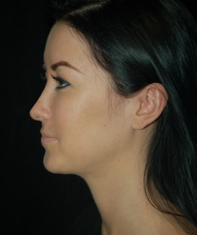 After thumbnail for Case 87 Rhinoplasty Before and After Photos