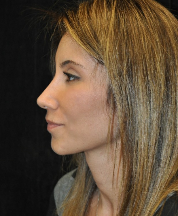 After thumbnail for Case 85 Rhinoplasty Before and After Photos