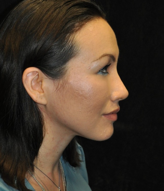 After thumbnail for Case 84 Rhinoplasty Before and After Photos