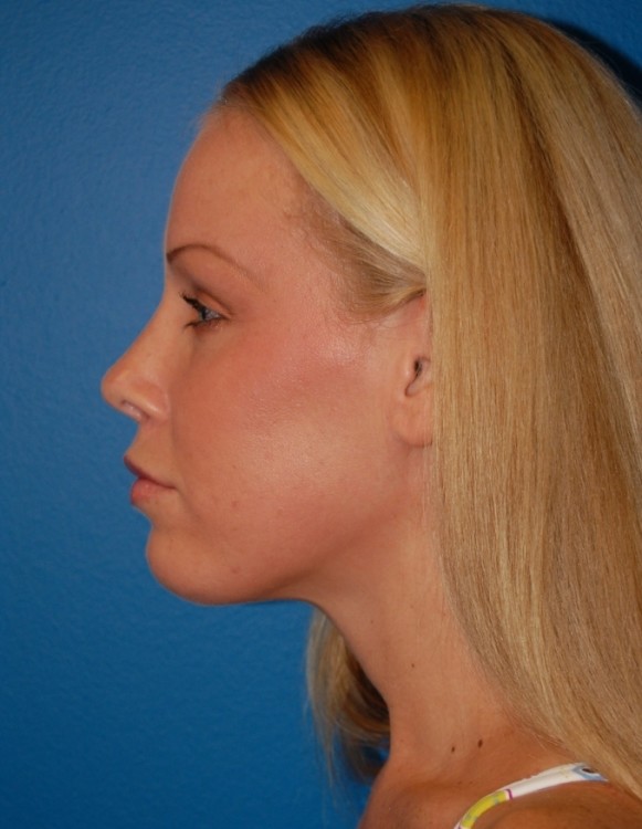 After thumbnail for Case 1 Rhinoplasty Revision Before and After Photos