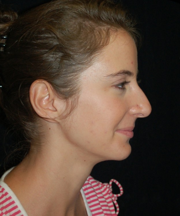 Before thumbnail for Case 4 Rhinoplasty Revision Before and After Photos