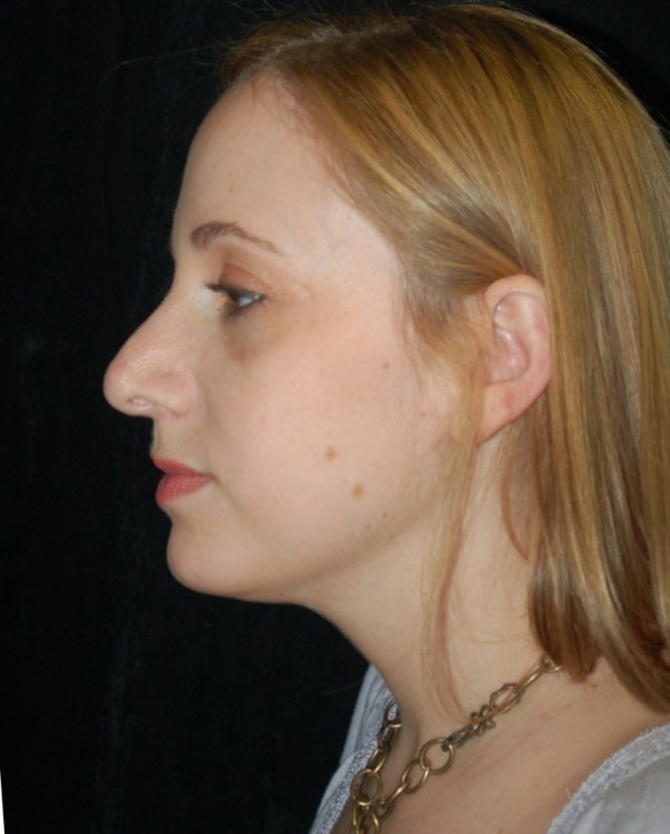Before thumbnail for Case 5 Rhinoplasty Revision Before and After Photos