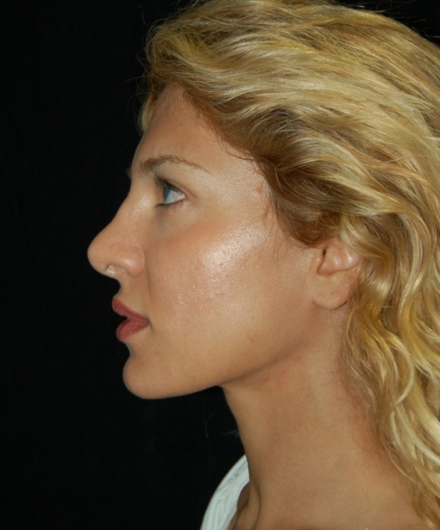 Before thumbnail for Case 10 Rhinoplasty Revision Before and After Photos