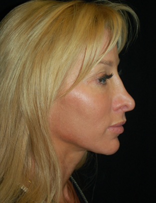 Before thumbnail for Case 11 Rhinoplasty Revision Before and After Photos