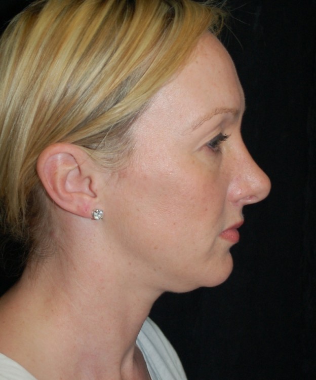 Before thumbnail for Case 13 Rhinoplasty Revision Before and After Photos