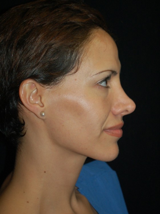 Before thumbnail for Case 17 Rhinoplasty Revision Before and After Photos