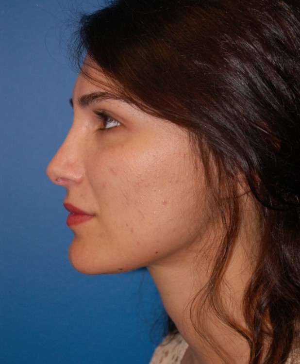 After thumbnail for Case 18 Rhinoplasty Revision Before and After Photos