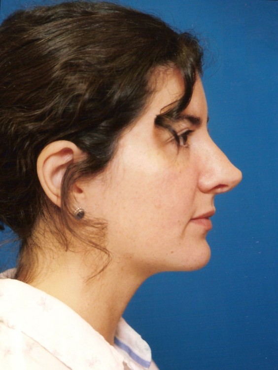 Before thumbnail for Case 19 Rhinoplasty Revision Before and After Photos