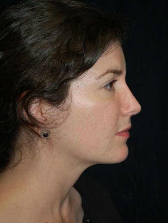 After thumbnail for Case 19 Rhinoplasty Revision Before and After Photos