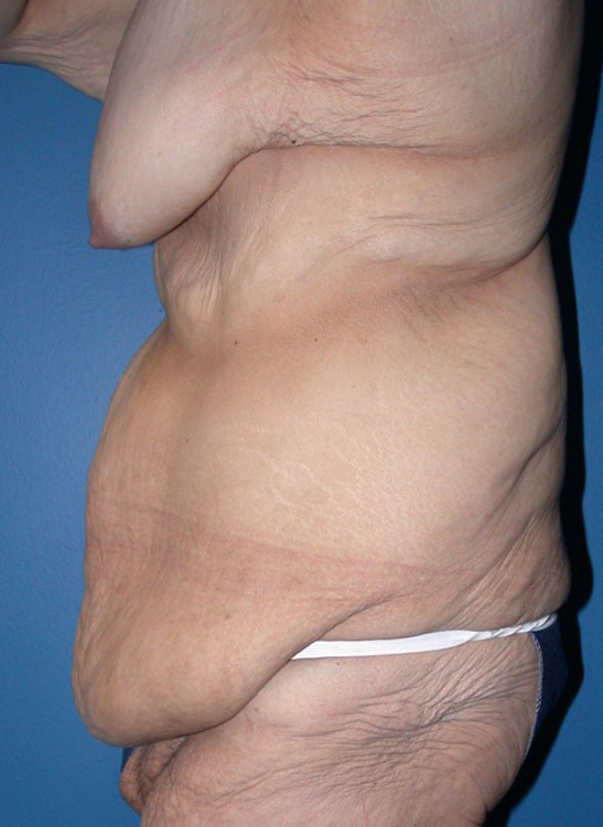 Before thumbnail for Case 1 CoolSculpting Before and After Photos