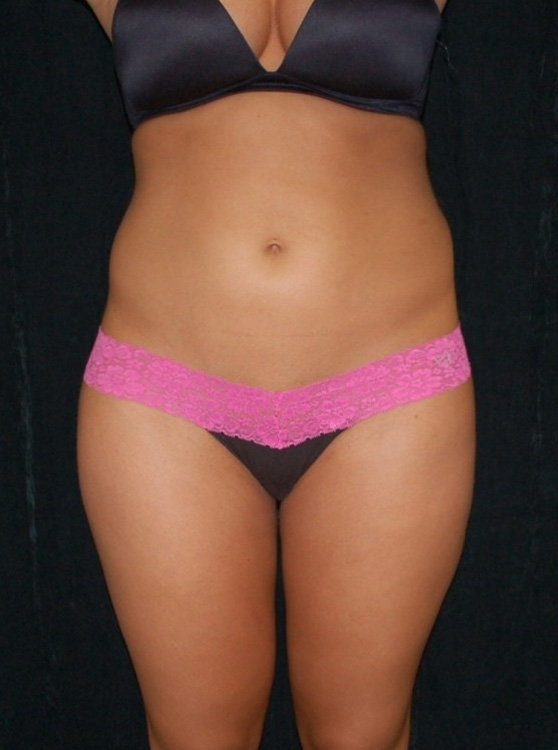 Another before picture for Case 1 Liposuction Before and After Photos