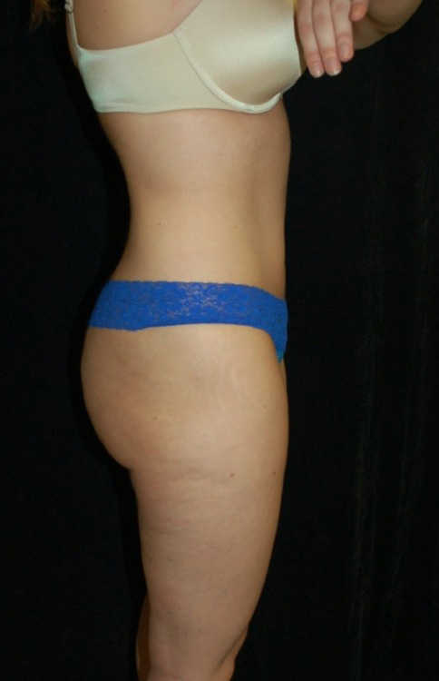 After thumbnail for Case 2 Liposuction Before and After Photos