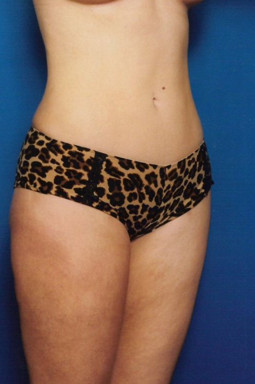 After thumbnail for Case 4 Liposuction Before and After Photos