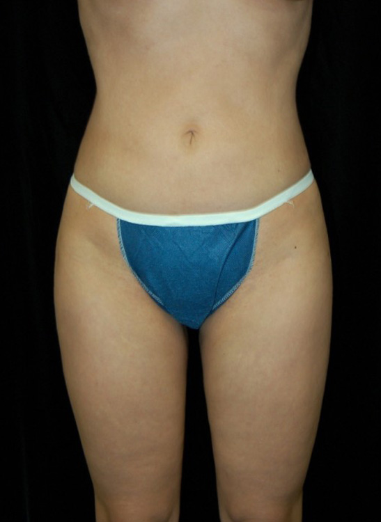 Another after picture for Case 5 Liposuction Before and After Photos