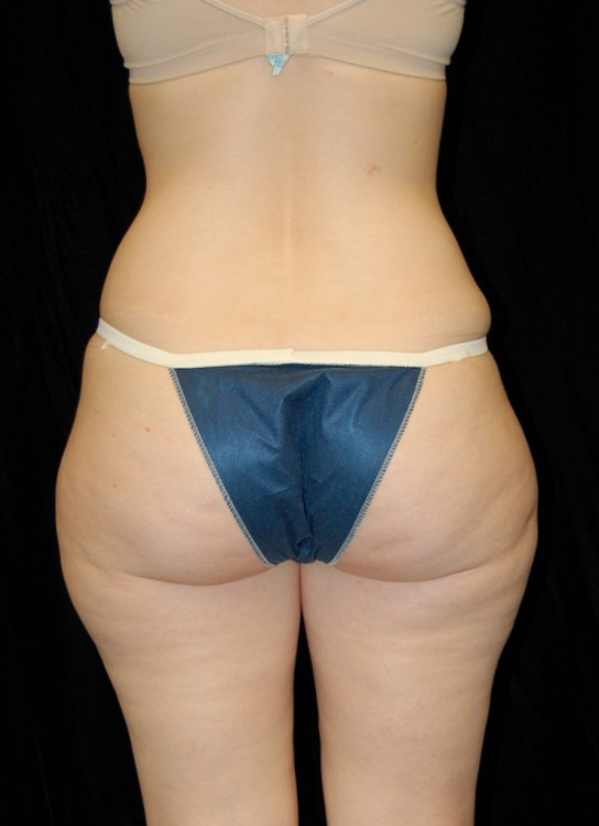Before thumbnail for Case 8 Liposuction Before and After Photos