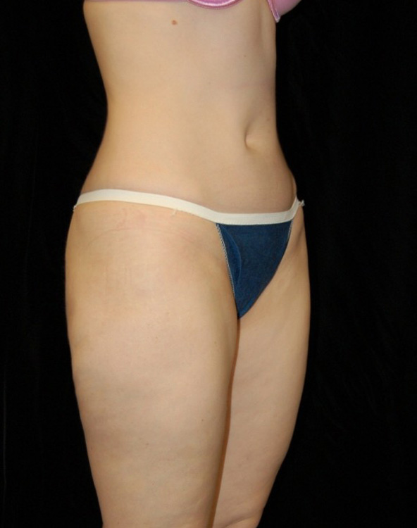 After thumbnail for Case 8 Liposuction Before and After Photos