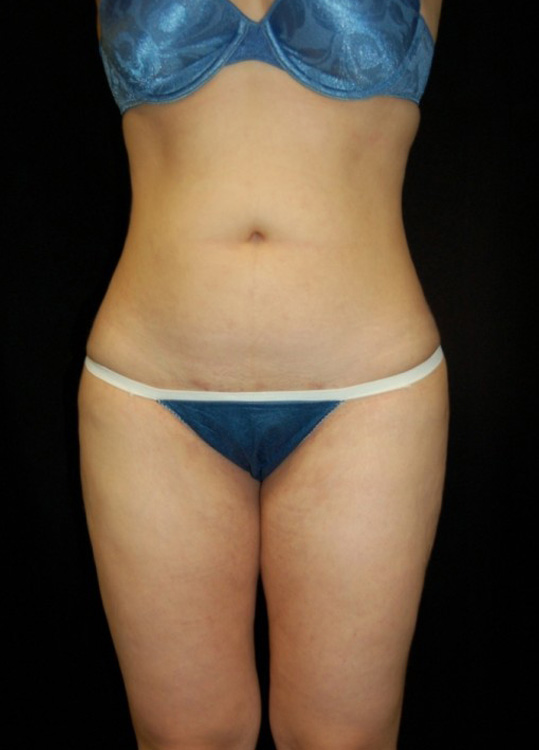 After thumbnail for Case 9 Liposuction Before and After Photos