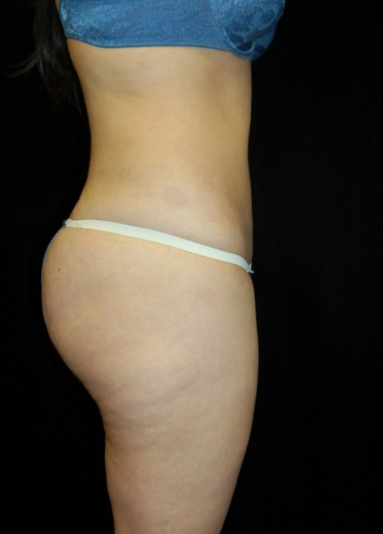 After thumbnail for Case 9 Liposuction Before and After Photos