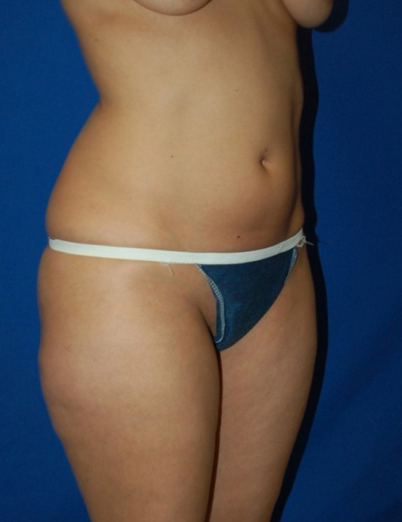 Before thumbnail for Case 11 Liposuction Before and After Photos