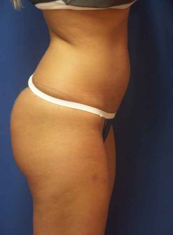 Before thumbnail for Case 12 Liposuction Before and After Photos