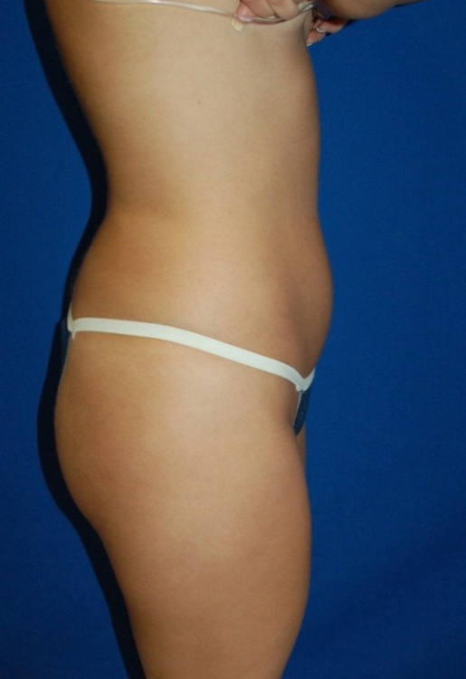 Before thumbnail for Case 13 Liposuction Before and After Photos