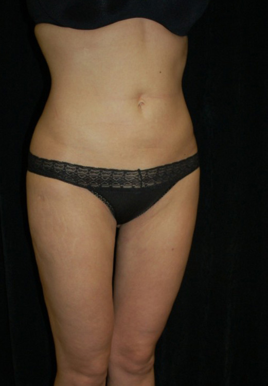 After thumbnail for Case 14 Liposuction Before and After Photos