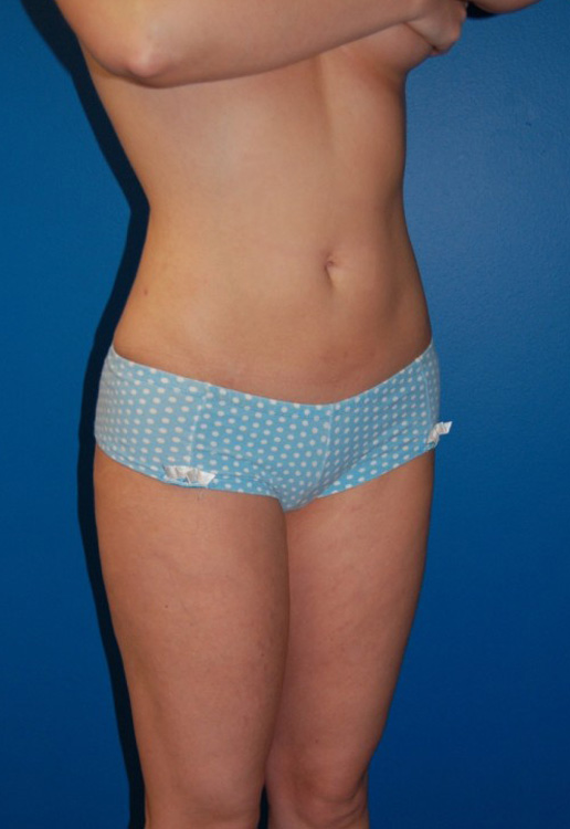 After thumbnail for Case 15 Liposuction Before and After Photos