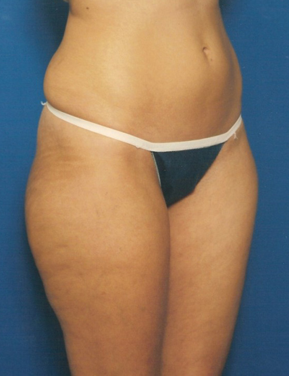 Before thumbnail for Case 16 Liposuction Before and After Photos