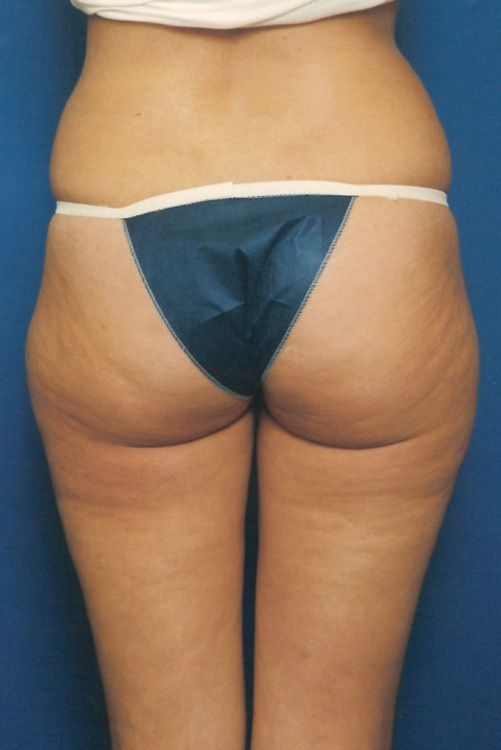 Before thumbnail for Case 16 Liposuction Before and After Photos
