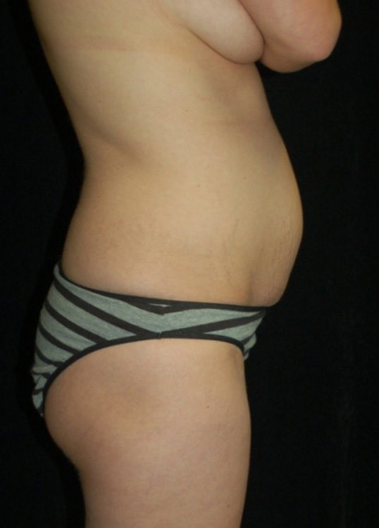 Before thumbnail for Case 7 Tummy Tuck Before and After Photos