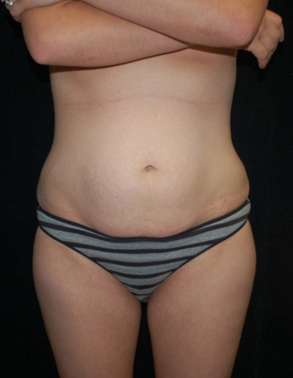 Before thumbnail for Case 7 Tummy Tuck Before and After Photos